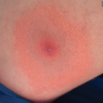 This 'bulls-eye' rash is characteristic of Lyme disease.